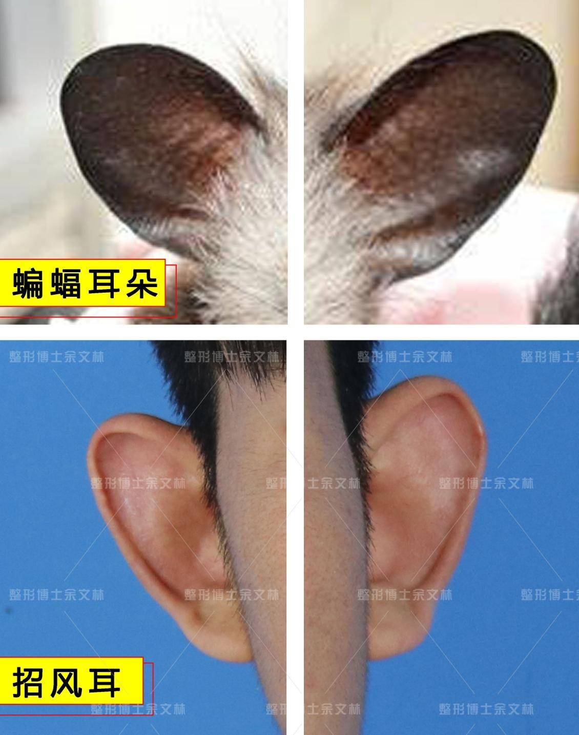 余文林科普：猿耳可以自己恢复好？猿耳畸形图片-健康160