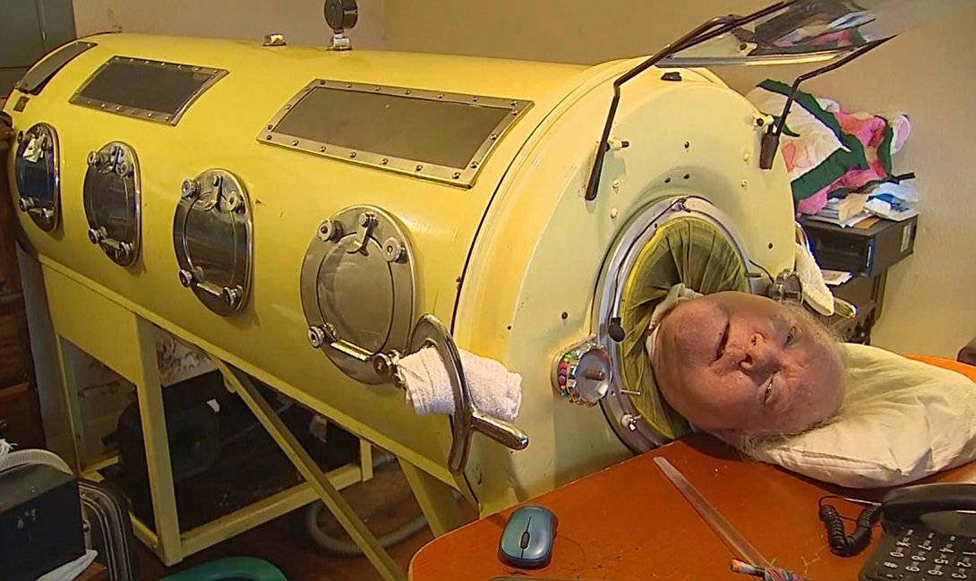 被困“铁桶”70年的铁肺人，一生无法呼吸，断电意味着死亡