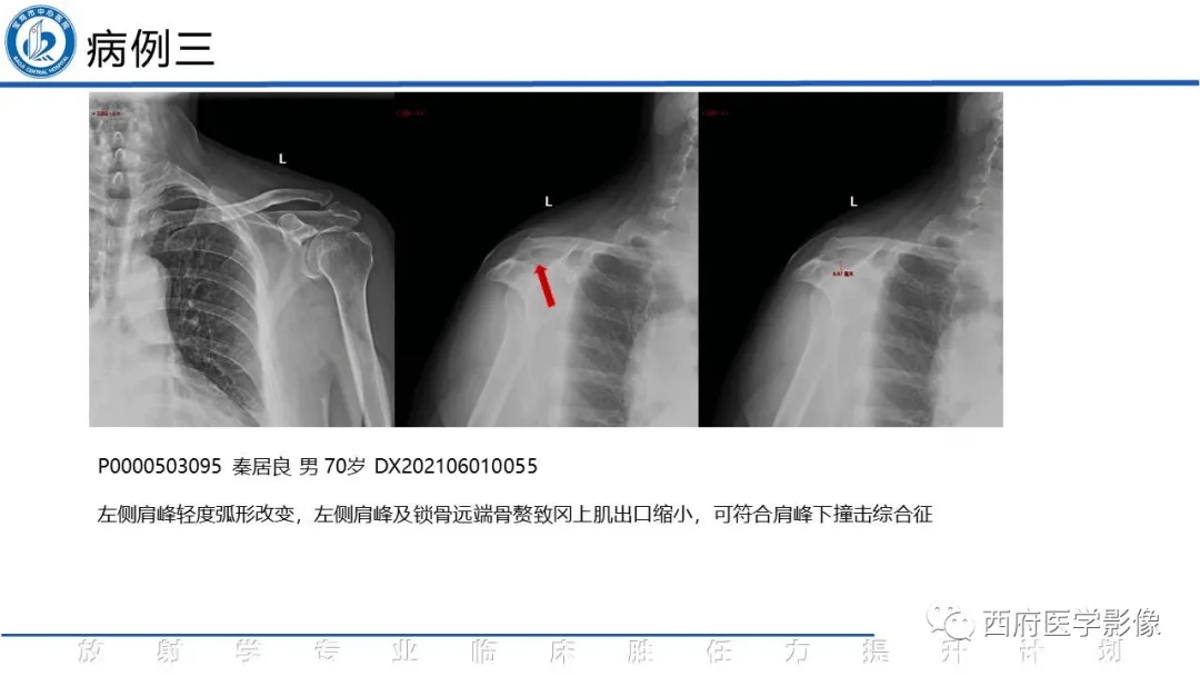 肩峰下撞击综合征影像断与鉴别诊断