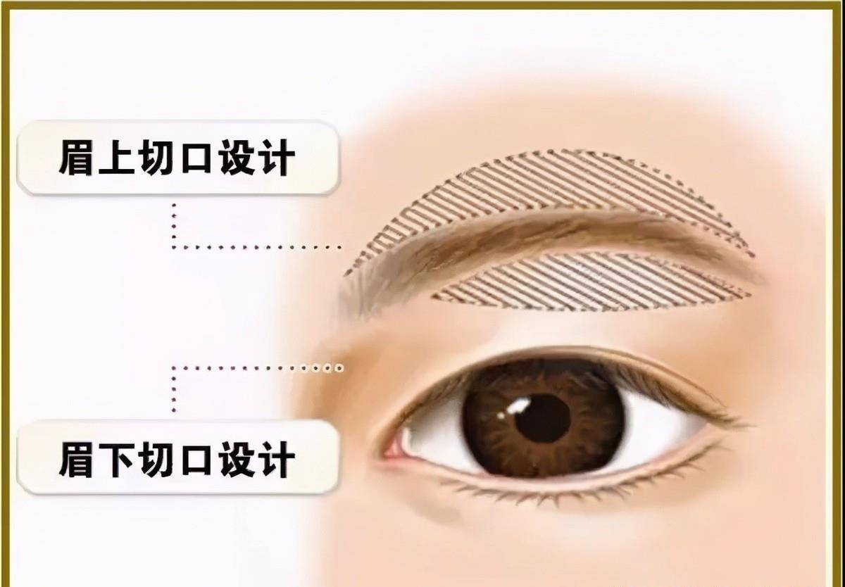 整形作为做过“提眉手术”的人，我来说几点真实的感受