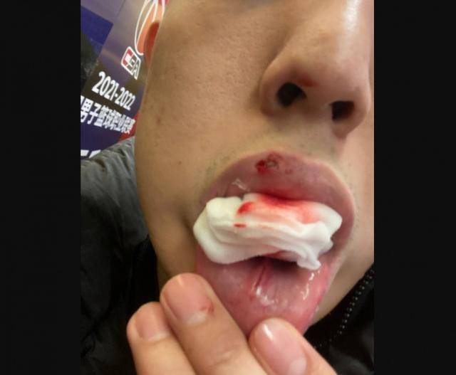 宋翔社媒晒沈梓捷伤情嘴部几处被打破咬着纱布打完全场