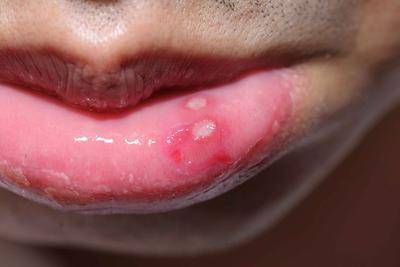 口腔溃疡反复发作—白塞病?