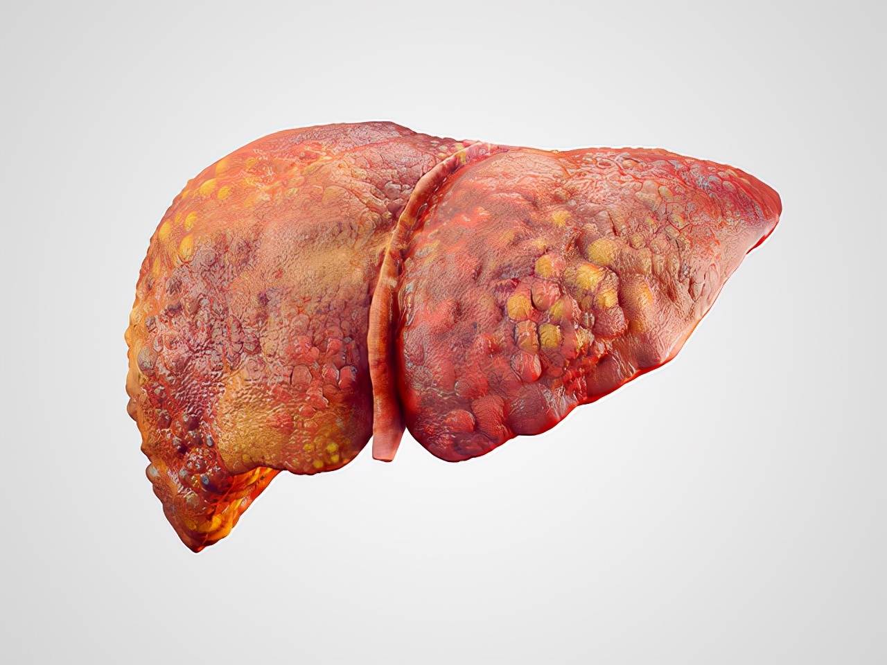 肝脏|如果肝脏有问题，或许手上有这“4个标志”，不妨了解一下