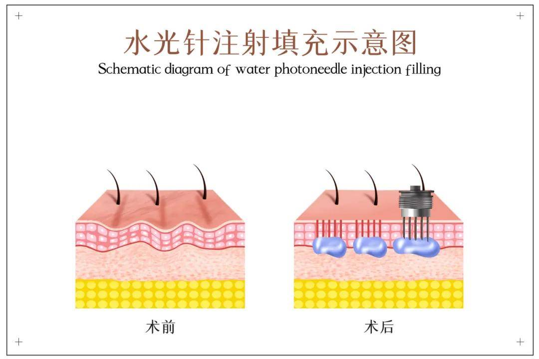 分子医美科普 | 水光针对皮肤有害吗？