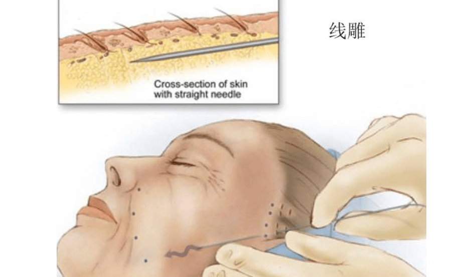 进行全面解读：全脸线雕包括几个部位？面部线雕一生能做几次？细品~