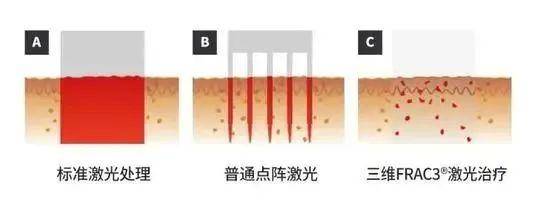 美容|Fotona4D美容 云南铜雀台杨才华讲解Fotona 4D Pro