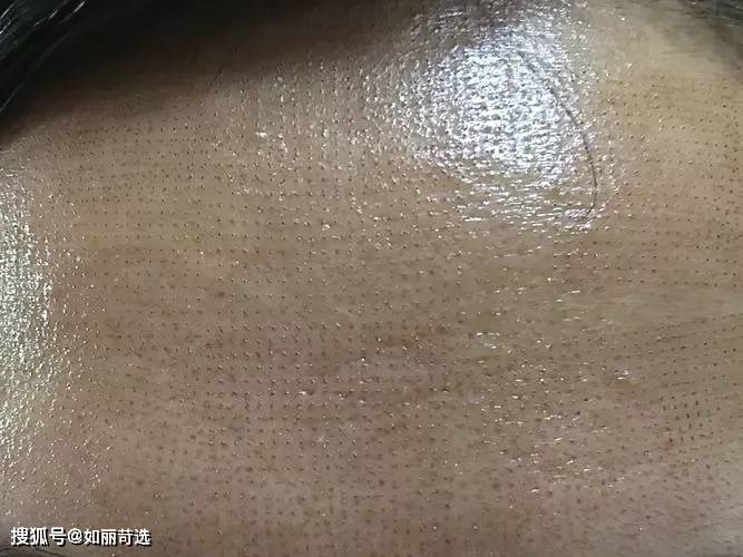 治疗毛孔粗大怎么办？收缩毛孔、改善毛孔问题必看!
