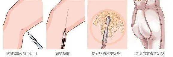 腰围酸了！男生的腿为什么比女生的还细？腿粗的妹子该怎么瘦腿？