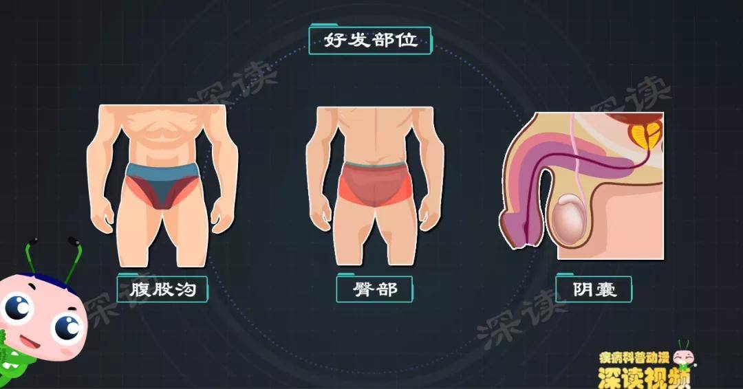 原创私处长疹子瘙痒溃烂生殖器疱疹发病率逐年上升这些症状你有吗