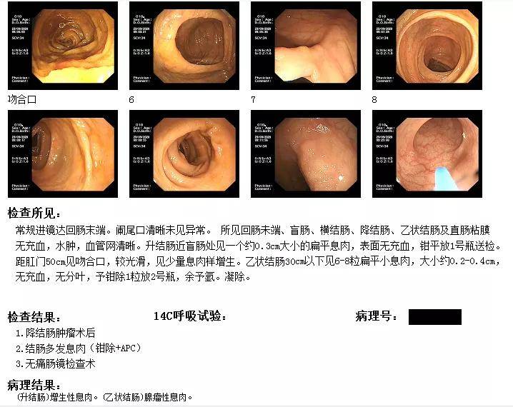 同時,在腸癌患者術後複查/監測方面,腸癌糞便基因檢測