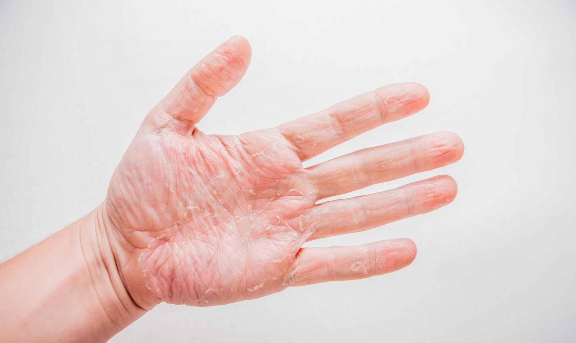 夏季,手部容易起泡脱皮,这是什么原因?