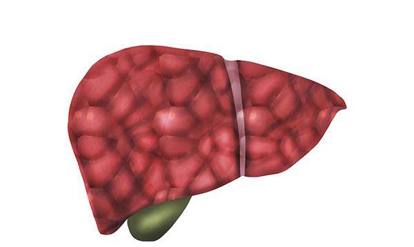 肝脏|体内的乙肝，如果进展为肝硬化了，身体会有什么信号？医生告诉你