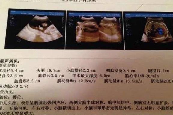 什么时候检查四维彩超 39e038ef14534ffebdc6d0854c258056.jpeg