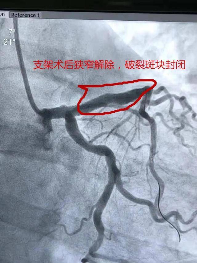 刘大爷|咸阳市第一人民医院：两次手术挽救生命之“心”