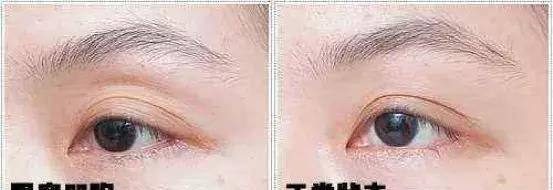 眉骨患11天痊愈后的Lisa，怎么完全认不出了…