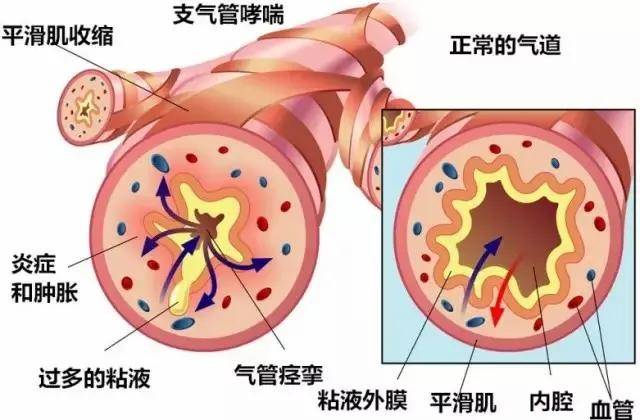 黏液|专家共识：气道廓清呼吸康复治疗，推荐西纳舒盐溶胶治疗仪