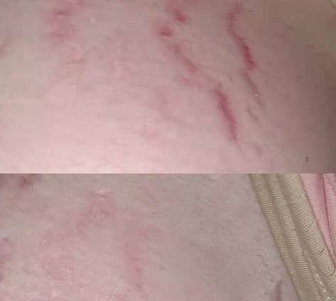 体重|妊娠纹也“挑人”？不是所有都长纹，孕妈：这三类中了就窃喜吧！