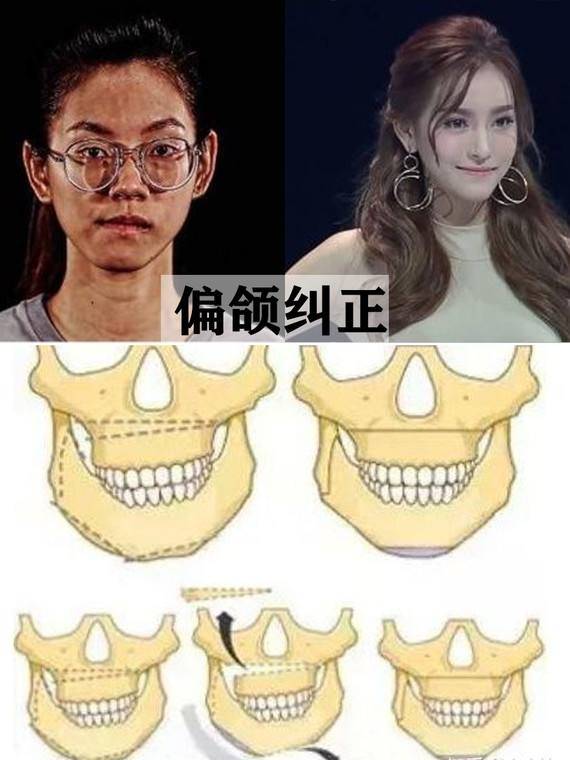 大小脸可以通过正颌永久改善吗?不做的话,脸会越来越歪吗?