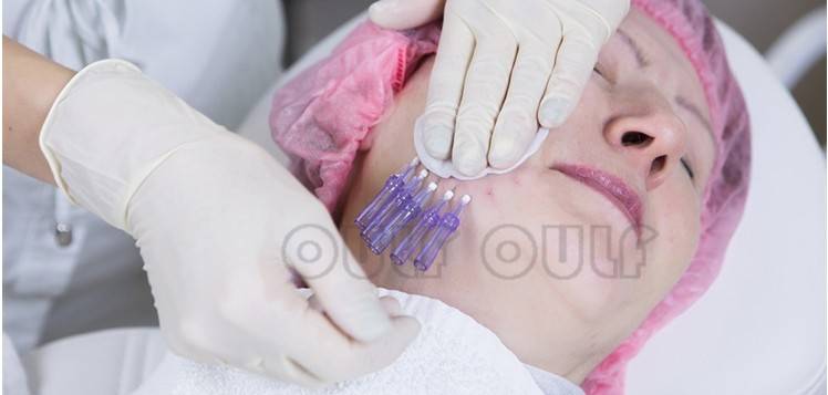 脸部谁知道刚做完线雕脸部有凹凸正常吗？蛋白线面部提升后遗症,好恨!!