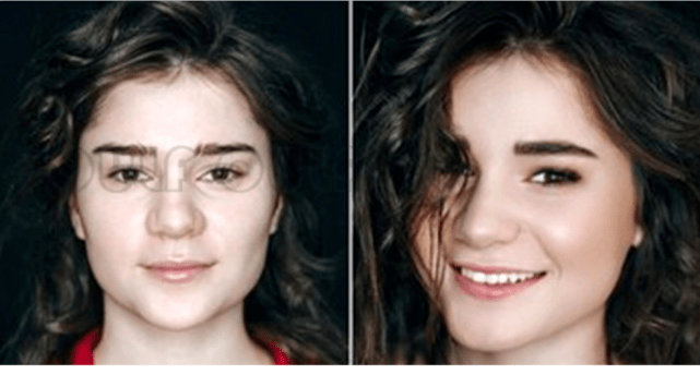 玛吉有没有人说说热玛吉打多少发、热玛吉后可以洗脸吗?