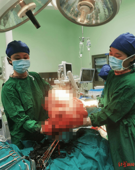 肿瘤|肚子突然膨胀！42岁女子腹大如怀双胞胎，取出20多斤重巨型肿瘤
