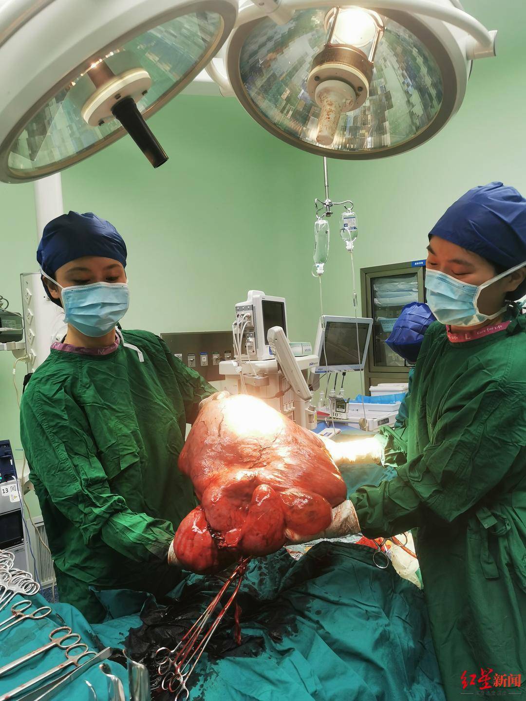 肿瘤|42岁女子腹大如怀双胞胎 手术取出20多斤重巨型肿瘤