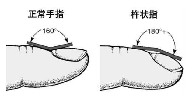 也叫做“杵状指”，很多肺病异变手指头末节都会出现粗大如小鼓槌一样。