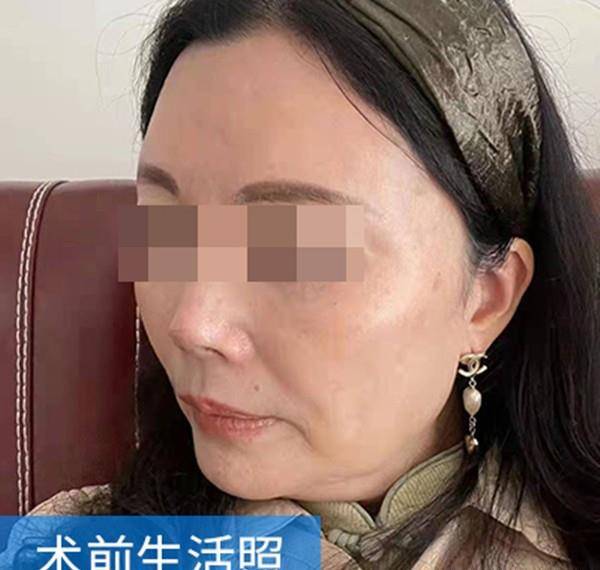 脸部拉皮术后20天记录：从松弛大妈到年轻小姐姐，我经历了什么？