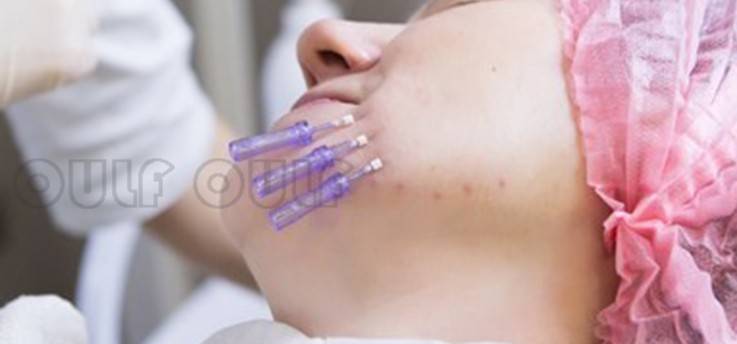 什么科普篇：ppdo线雕是什么线？ppdo线雕维持时间？