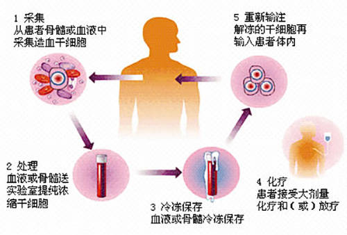 济南|济南血液病医院：淋巴瘤自体移植“不可或缺”，这些患者更易获益