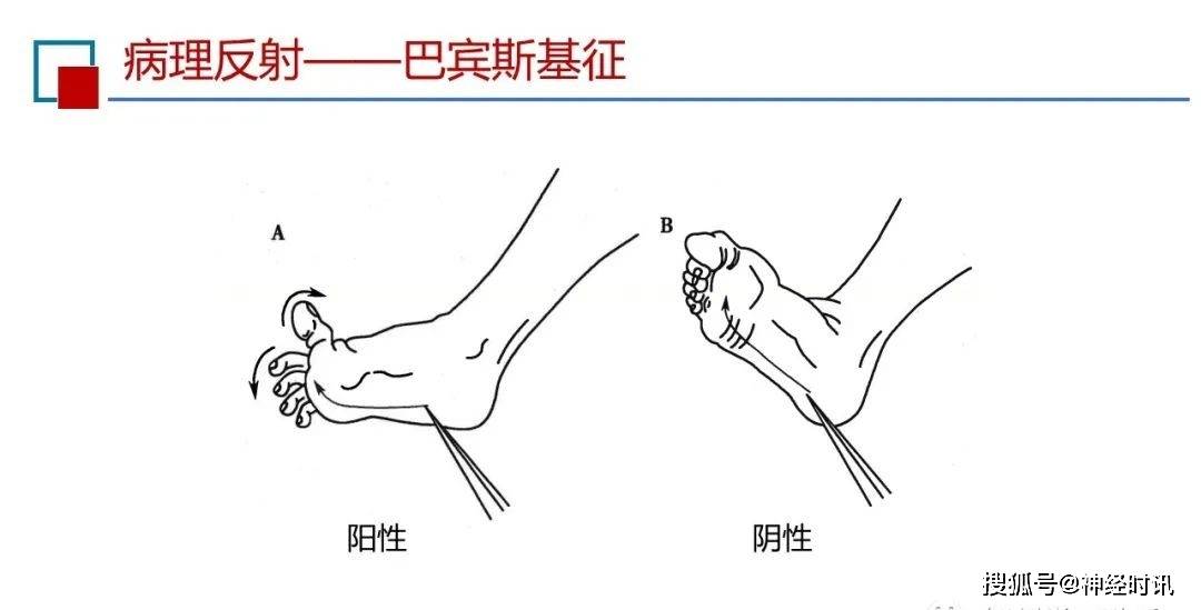 babinski征阳性图片