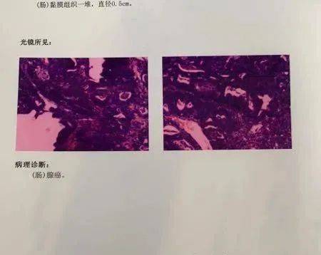 肠癌肠镜检查报告图片图片