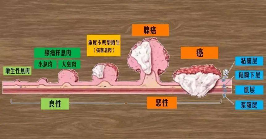 直肠息肉会癌变吗?做到这5条有效预防!