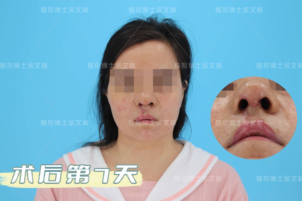 案例分析愛美的唇裂患者46歲還來做手術修復鼻畸形