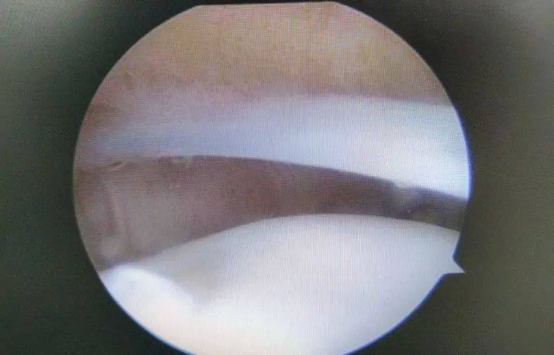 膝关节"弹响"需当心"膝关节滑膜皱襞综合征"_检查_治疗_儿童