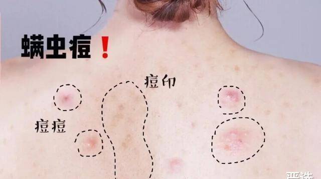 寄生螨虫若在身上“寄生”，头部早有“提示”！教你几个妙招快速除螨