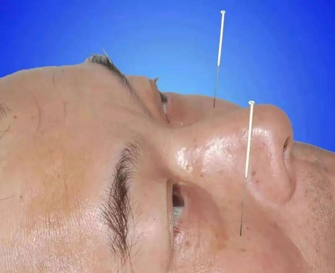 中极穴配三阴交,阴陵泉,肝胆脾俞:治疗糖尿病及其所导致的膀胱残余尿3