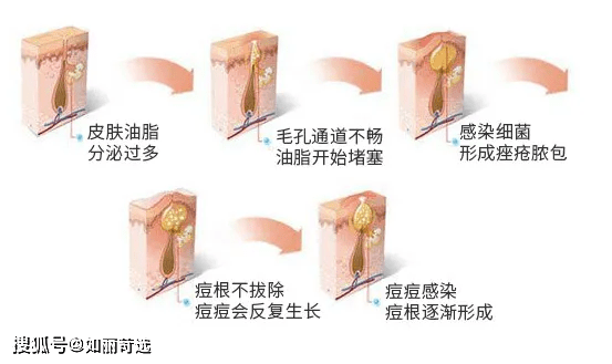 治疗痘痘只能靠医美手段改善吗？