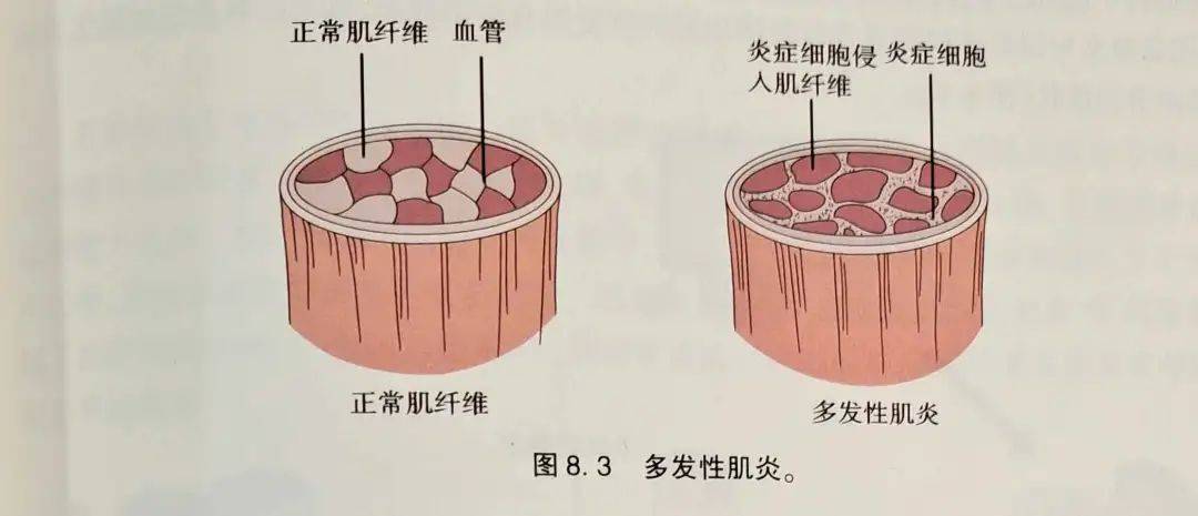 多发性肌炎和皮肌炎均是自身免疫性肌病