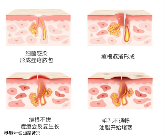 治疗痘痘只能靠医美手段改善吗？