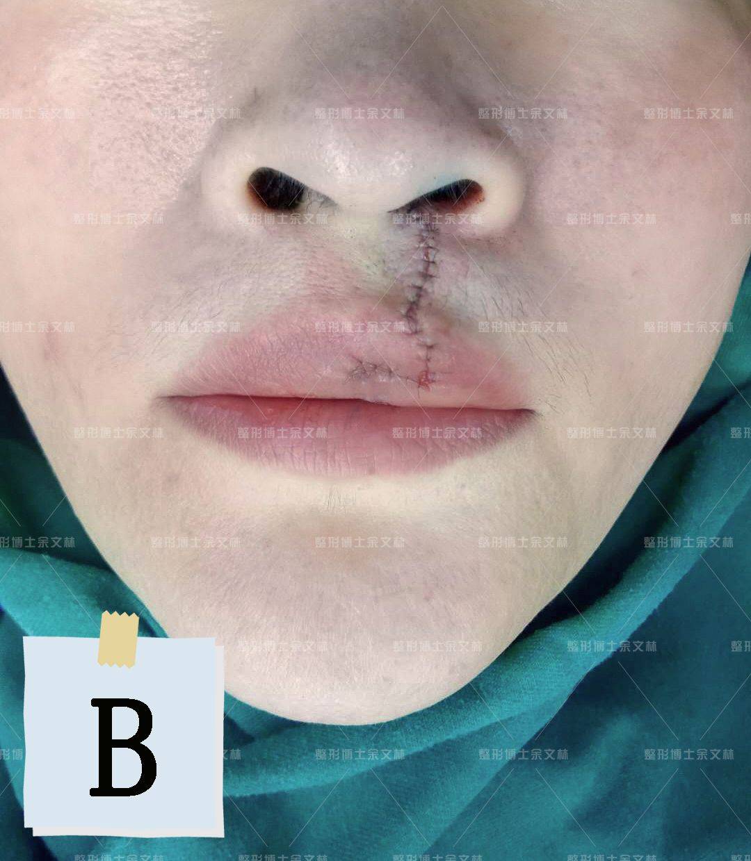 【案例分析】42岁患者不想被唇裂影响一辈子,手术修复红唇畸形