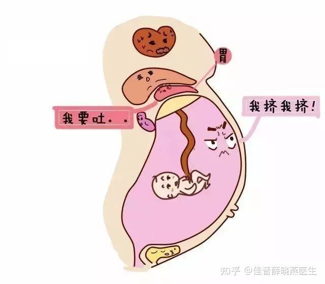 到了孕晚期,孕妈不断增大的子宫,继续鸠占鹊巢,向上压迫胃部,胃内酸性