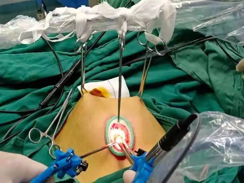 最微创的手术方式:湘潭县人民医院经脐单孔免气腹腹腔镜手术