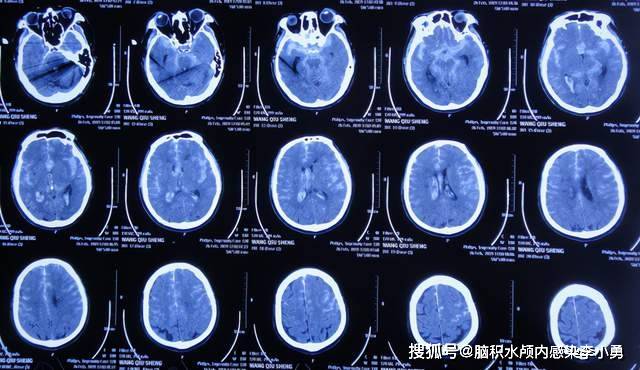 急送到辽宁省葫芦岛市某医院,查脑ct示脑出血(图-1),给予脱水降颅压