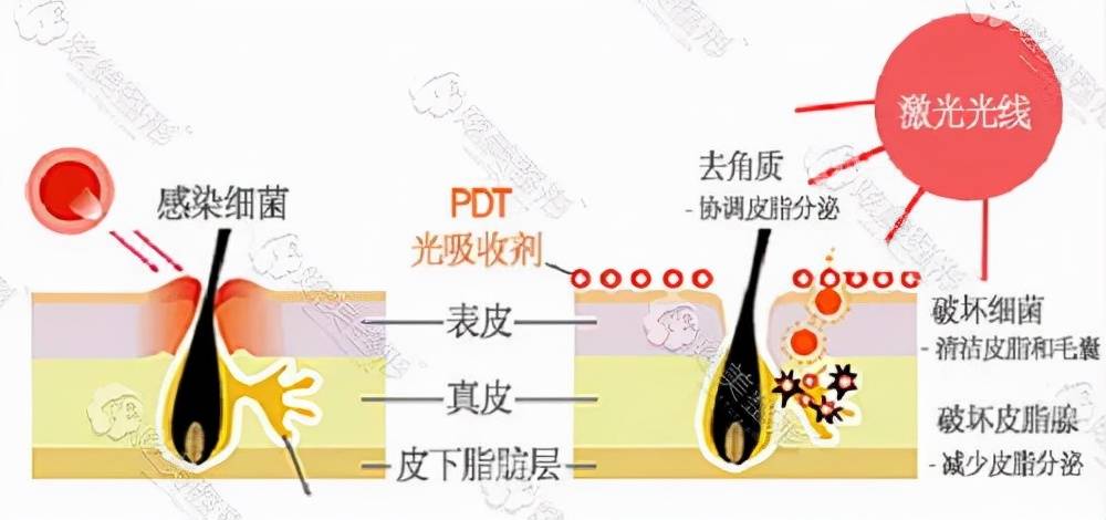 治疗敏感肌分几种类型？敏感肌如何治疗？