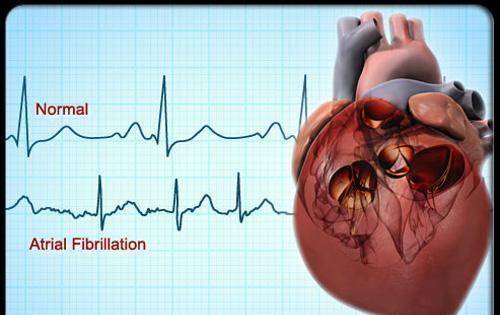 我国|最新调查：我国心脏房颤发病率最高，这个心脏病导致中风高5倍