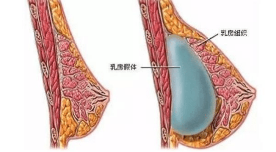 后者术后形态更接近于天然的乳房,受到更多东方女性的青睐,对手术技术