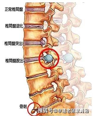 非遗老张家膏贴腰椎间盘突出坐行卧应该注意什么
