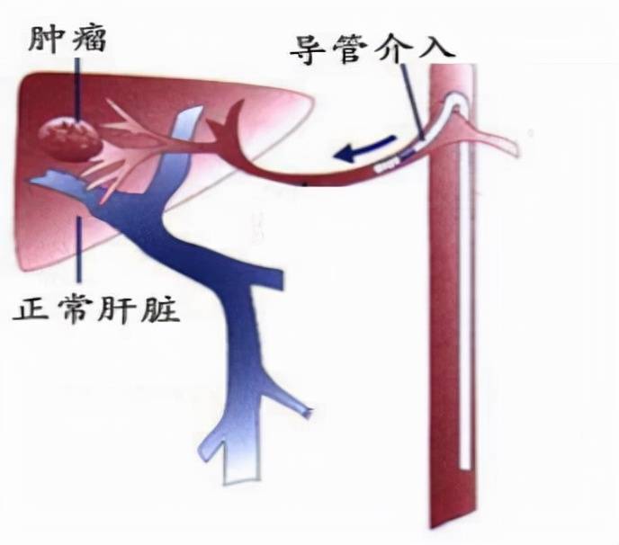 经肝动脉化疗栓塞术(tace)是目前临床应用最多的治疗方法.