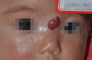 婴幼儿血管瘤可以祛除吗